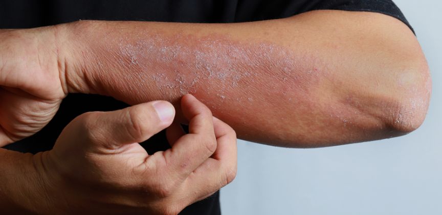 eczema and psoriasis