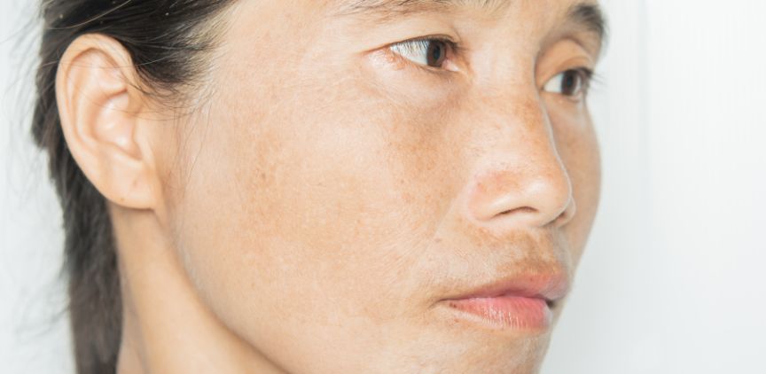 dark spots on face
